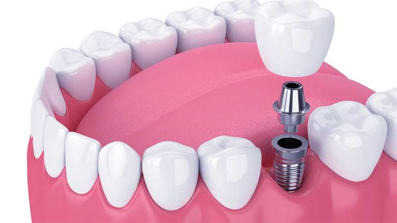 Dental Implants